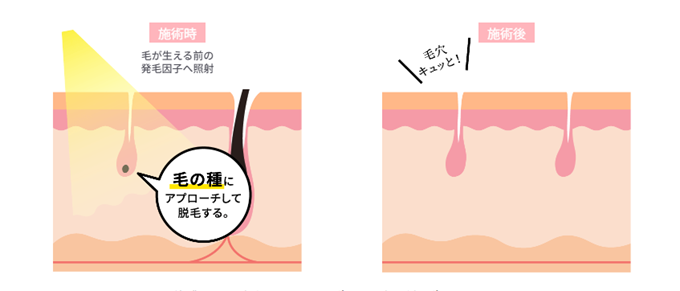 ハイパースキン脱毛の仕組み