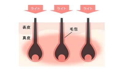 リンリンの脱毛方法