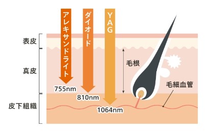 ソプラノチタニウム