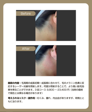 城本クリニックのうなじ脱毛