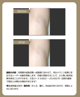 城本クリニックの脱毛の効果